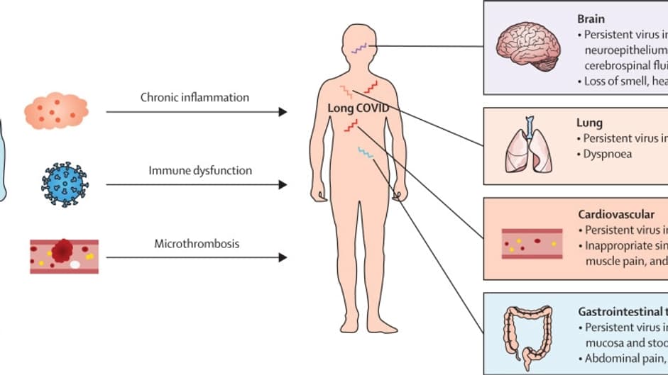 Exemples de COVID longs qui pourraient être entraînés par la persistance du SARS-CoV-2 dans l'organisme, selon une étude de The Lancet