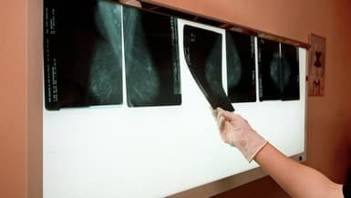 Un médecin examine dans son cabinet médical à Arcueil les radios du sein d'une patiente afin de détecter un éventuel cancer, en 2001.