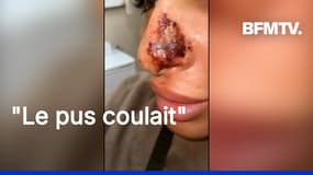  "Elle m'a dit que c'était l'hématome": les injections illégales de botox font des ravages 