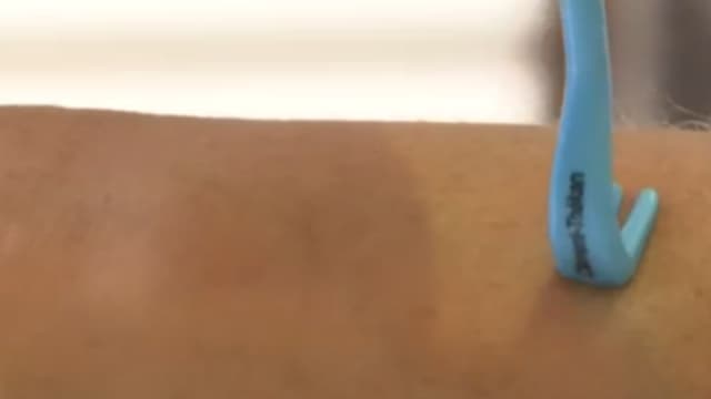 Chaque année 27.000 nouveaux cas de Lyme sont déclarés