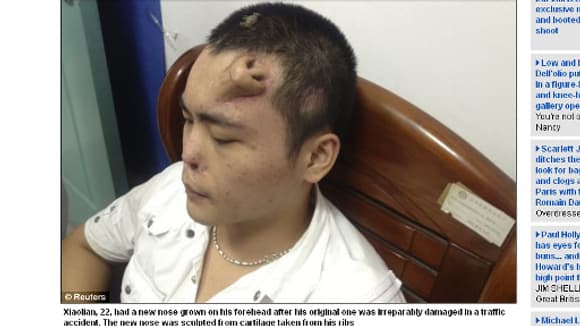 Xiaolan, un Chinois a la face mutilée par un accident de voiture, a un nez sur le front.