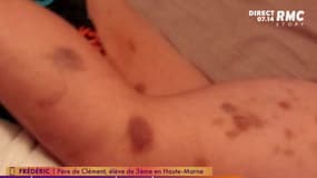 Le corps couvert de bleus d'un jeune de 14 ans harcelé au collège