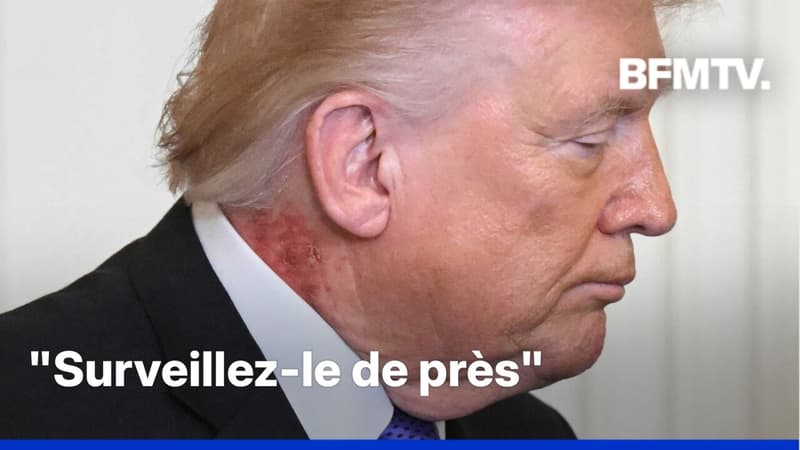 Une plaque rouge dans le cou de Donald Trump interroge, son médecin s'exprime