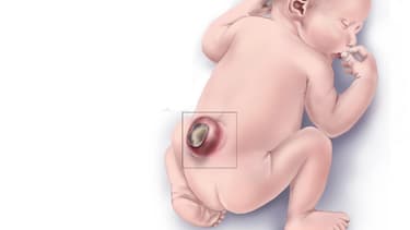 Illustration d'un cas de Spina bifida.