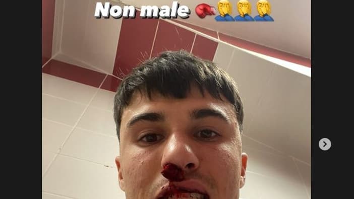 Alessandro Bianco poste une photo de son visage après avoir été frappé par un supporter de Sivasspor Alessandro Bianco poste une photo de son visage après avoir été frappé par un supporter de Sivasspor