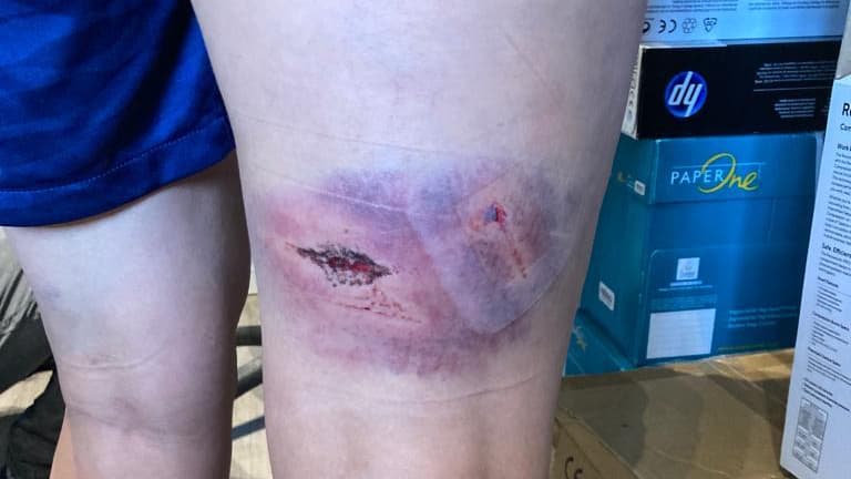 Les hématomes sur les jambes de Kheira Hamraoui, agressée le 4 novembre 2021