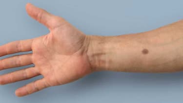 Dès que le taux de calcium augmente de manière prolongée, la mélanine est produite, laissant apparaître un grain de beauté artificiel.