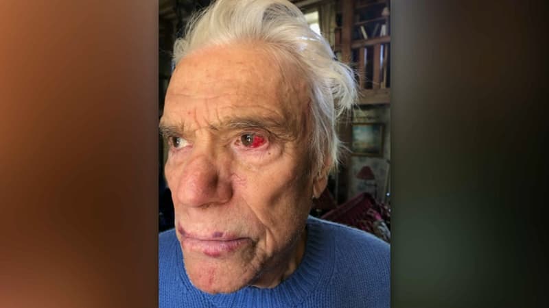 Bernard Tapie après avoir été agressé lors d'un cambriolage à son domicile, dimanche 4 avril 2021