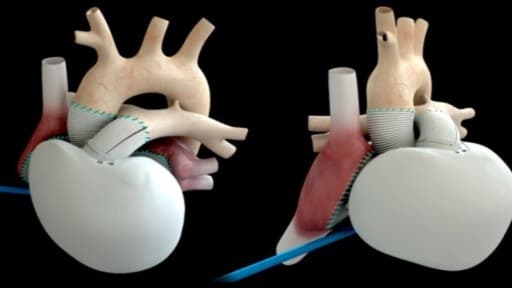 Le coeur artificiel de Carmat a été implanté sur un patient en France.