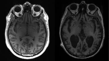 Un cerveau sain (à gauche) et un cerveau d'une personne atteinte de la maladie d'Alzheimer (à droite).