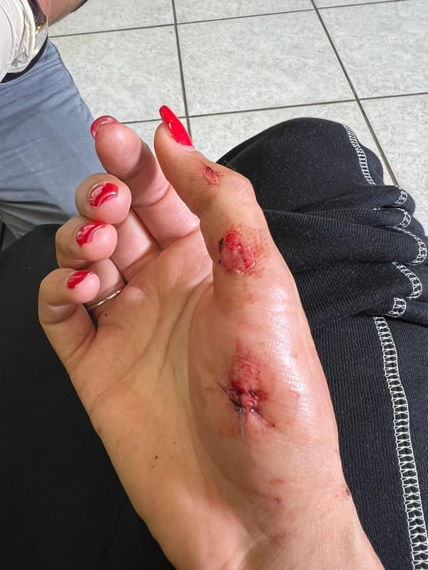 Les blessures de Kheira Hamraoui, agressée le 4 novembre 2021