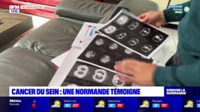 Cancer du sein:  une Normande témoigne