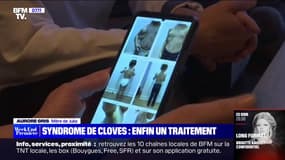 Un traitement efficace contre le syndrome de Cloves 