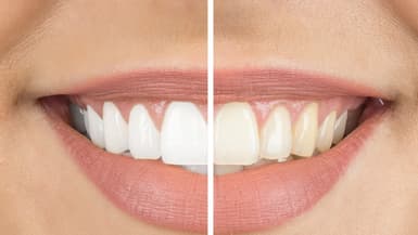 Les informations à savoir sur le blanchiment des dents remboursement mutuelle