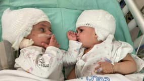 Des siamoises se sont vues pour la première fois après une opération en Israël le 5 septembre