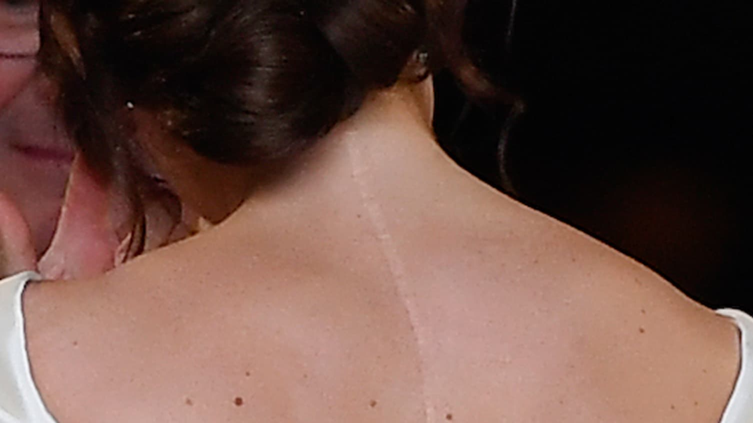 La cicatrice de la princesse Eugenie La cicatrice de la princesse Eugenie