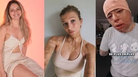 Laura Borg, Julie Bourges et Olivier Ferrand ont tout les trois étaient gravement brûlés lors d'accidents (de gauche à droite).