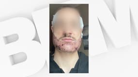 Mathieu a subi une greffe de barbe ratée.