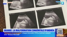 Orange: la malformation congénitale d'Andréa