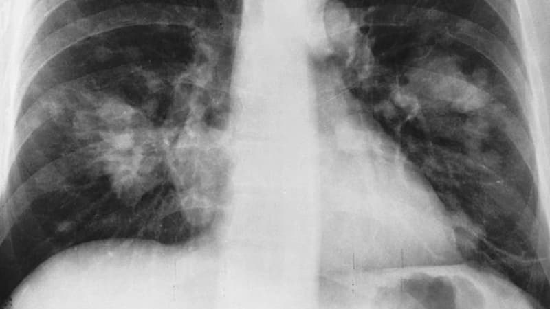 Radiographie du thorax montrant un cancer probable du poumon (taches claires à droite de chacun des poumons).