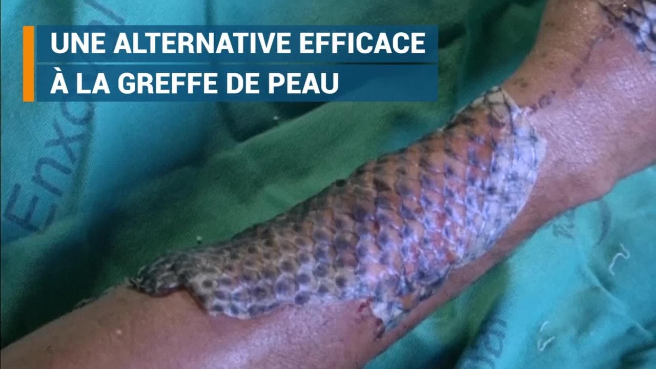 La peau de ce poisson peut soigner les brûlures