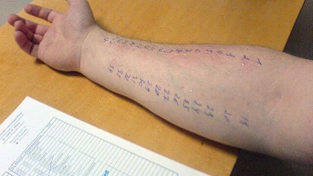 Un test allergique cutané, ou "prick test". (image d'illustration)