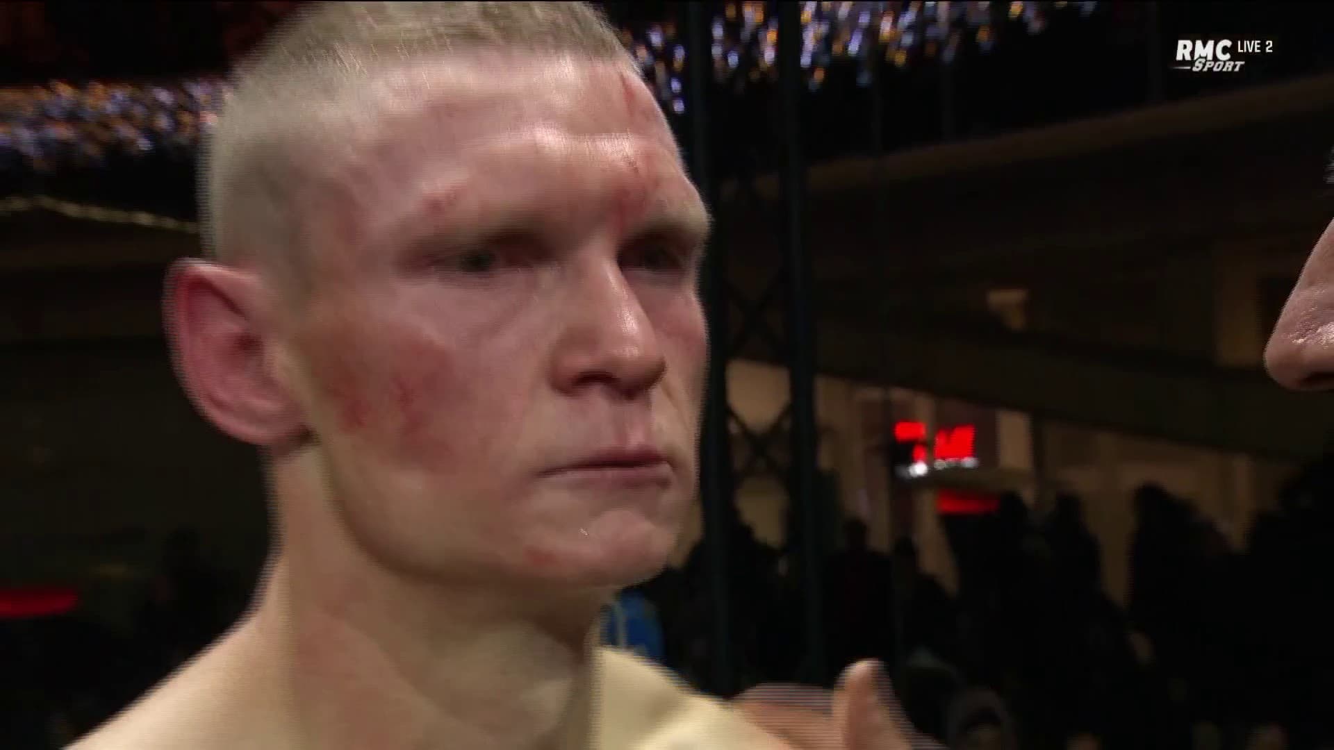 The scarred face of Australian Wade Ryan after his defeat against Bakary Samaké at the Forum des Halles de Châtelet, November 23, 2024 The scarred face of Australian Wade Ryan after his defeat against Bakary Samaké at the Forum des Halles de Châtelet, November 23, 2024
