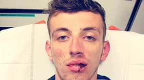 Pour témoigner, Raphaël a publié la photo de son visage tuméfié sur Facebook.