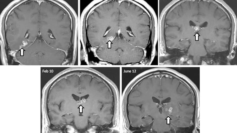 Les médecins ont diagnostiqué un ver solitaire dans le cerveau d'un homme qui se plaignait de maux de tête.