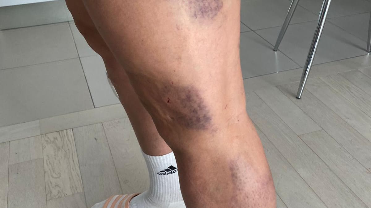 Les hématomes sur les jambes de Kheira Hamraoui, agressée le 4 novembre 2021