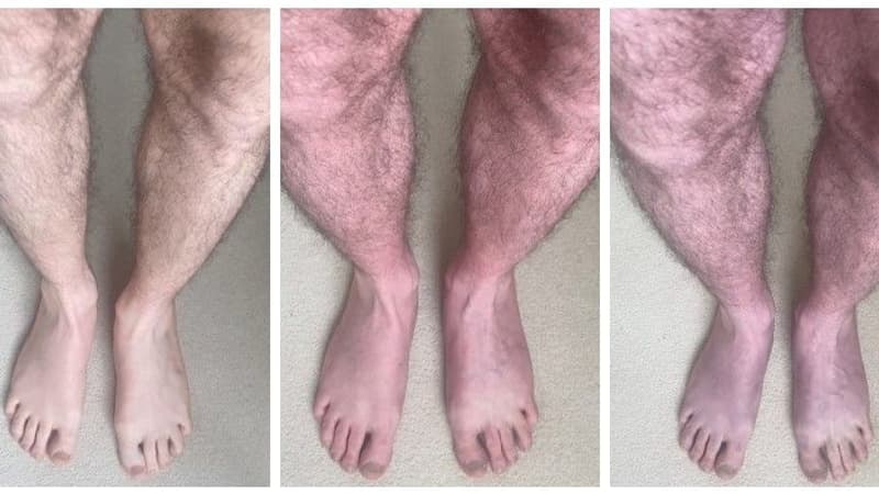 Un patient de 33 ans souffre de "jambes bleues", un symptôme nouvellement identifié en association avec un Covid long, par des chercheurs de l'université de Leeds
