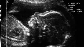 Echographie d'un fœtus réalisée cinq mois après la conception. (Illustration)