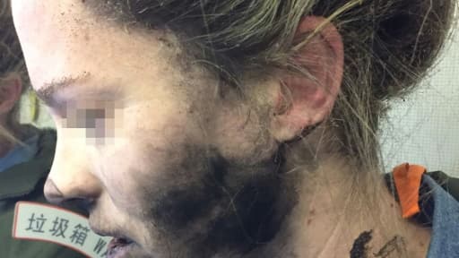 Photo prise le 19 février 2017 d'une Australienne brûlée au visage et au cou par ses écouteurs qui ont pris feu durant un vol entre Pékin et Melbourne