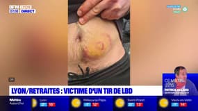Retraites: victime d'un tir de LBD à Lyon