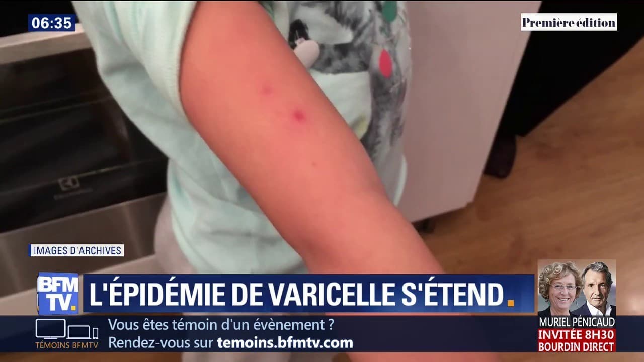 L'épidémie de varicelle continue de s'étendre et touche déjà 12 régions