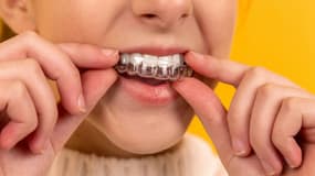 Les gouttières d'alignement dentaires permettent d'aligner les dents.