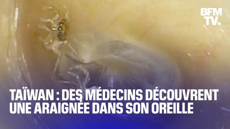 Taïwan: des médecins découvrent une araignée dans l'oreille d'une patiente