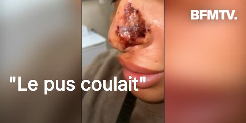 "Elle m'a dit que c'était l'hématome": les injections illégales de botox font des ravages