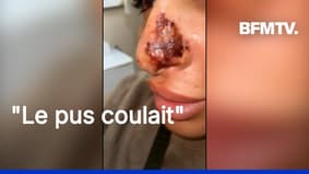  "Elle m'a dit que c'était l'hématome": les injections illégales de botox font des ravages 