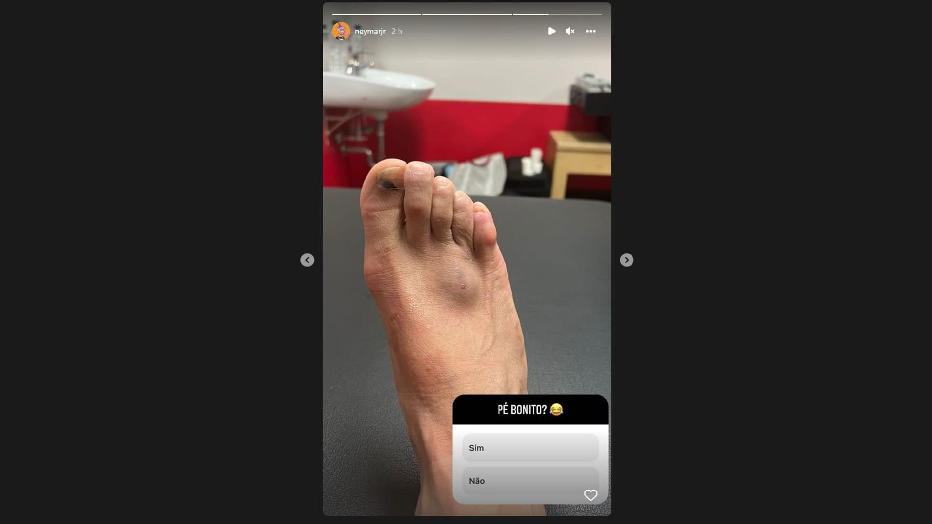 Le pied blessé de Neymar, le 1er juin 2022