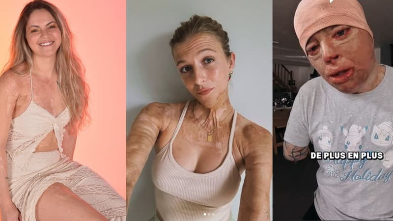 "Un après est possible": le message d'espoir de grands brûlés aux victimes de Crans-Montana et à leurs familles