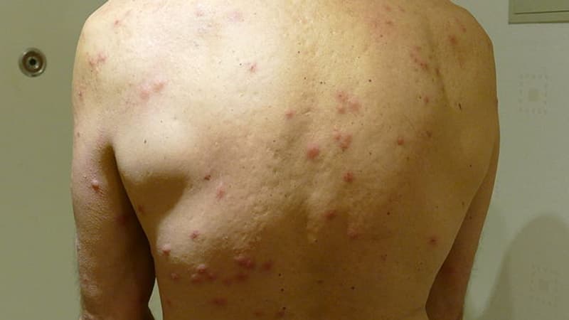 Un homme avec des piqûres de punaises de lit, dans un hôtel à Amsterdam, aux Pays-Bas, le 26 novembre 2015 Un homme avec des piqûres de punaises de lit, dans un hôtel à Amsterdam, aux Pays-Bas, le 26 novembre 2015