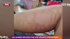 Brûlures et cloques après une épilation à la lumière pulsée