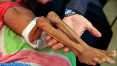 A l'hôpital de Sanaa, capitale du Yemen, le 6 octobre 2018.