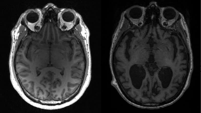 Cette IRM, donnée par l'un des auteurs de l'étude, montre un cerveau sain (à gauche) en comparaison avec un cerveau touché par Alzheimer (les zones noires montrant le rétrécissement du cerveau) 