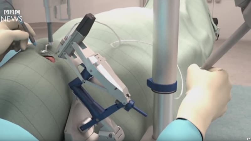 Le robot chirurgical R2D2.