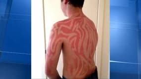 Le Sunburn art, la mode dangereuse du tatouage coup de soleil