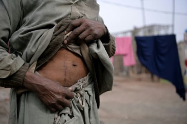 Un homme ayant vendu un rein montre sa cicatrice à Bhalwal au Pakistan, le 2 février 2017