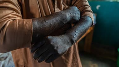 Un patient infecté par le mpox à Kamituga, le 20 septembre 2024 dans l'est de la RDC. Photo d'illustration