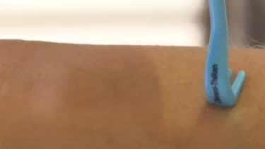 Chaque année 27.000 nouveaux cas de Lyme sont déclarés